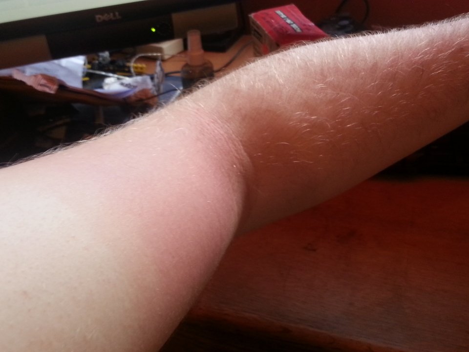 Nasty case of welders tan today from yesterdays wo…